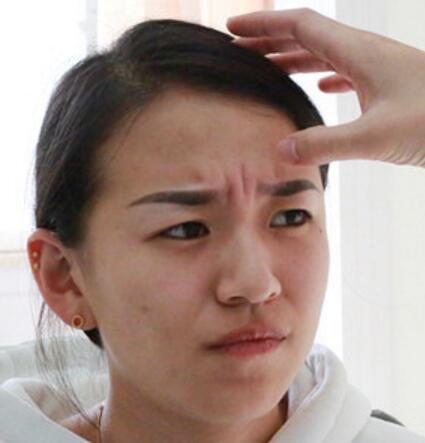 注射瘦臉去抬頭紋眉間紋恢復(fù)過程圖，真實(shí)案例分享