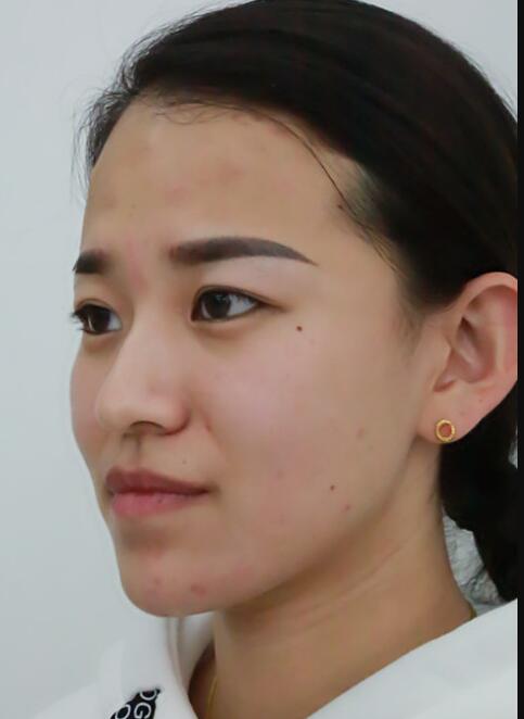 注射瘦臉去抬頭紋眉間紋恢復(fù)過程圖，真實(shí)案例分享