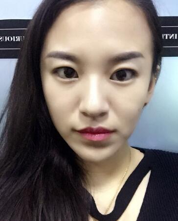 注射瘦臉去抬頭紋眉間紋恢復(fù)過程圖，真實(shí)案例分享