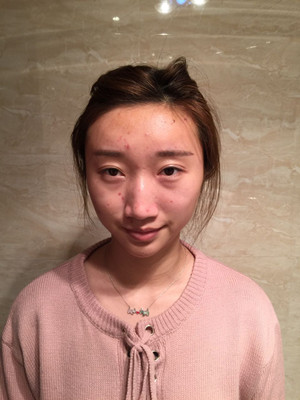 濰坊華美童艷梅醫(yī)生做的面部脂肪填充，大家來看看果怎么樣