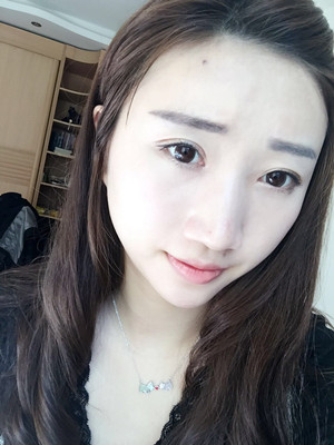 濰坊華美童艷梅醫(yī)生做的面部脂肪填充，大家來看看果怎么樣