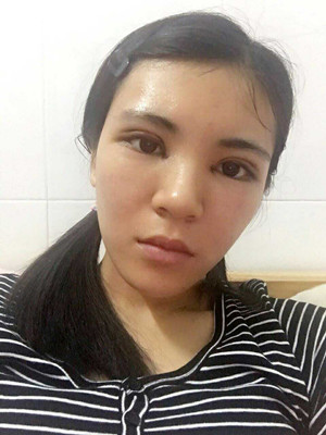 青?？等A馬晶醫(yī)生切開(kāi)雙眼皮真實(shí)案例分享