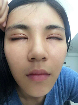 青海康華馬晶醫(yī)生切開(kāi)雙眼皮真實(shí)案例分享