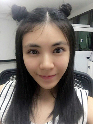 青?？等A馬晶醫(yī)生切開(kāi)雙眼皮真實(shí)案例分享