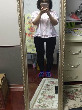 廣州美萊羅延平做的大腿環(huán)吸整形恢復(fù)果過程案例