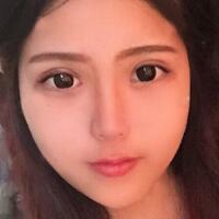 切開雙眼皮+開眼角前后對(duì)比圖和恢復(fù)過程分享