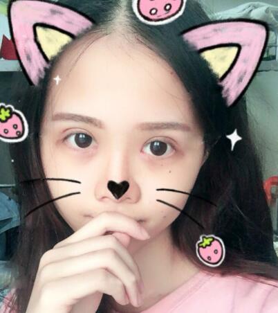 切開雙眼皮+開眼角前后對比圖和恢復過程分享