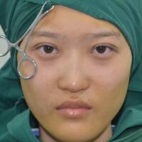 切開雙眼皮多少錢？割雙眼皮真實(shí)案例多對(duì)比圖分享