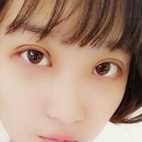 切開雙眼皮多少錢？割雙眼皮真實(shí)案例多對(duì)比圖分享