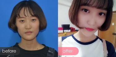 切開雙眼皮多少錢？割雙眼皮真實案例多對比圖分享