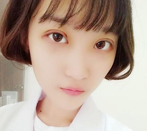 切開雙眼皮多少錢？割雙眼皮真實案例多對比圖分享