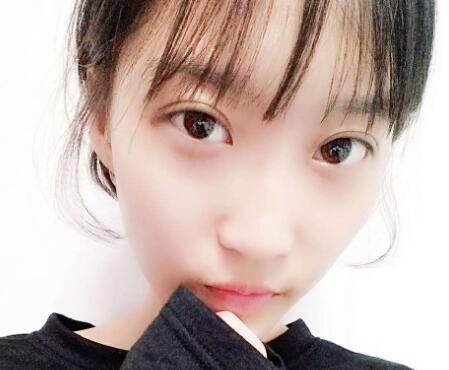 切開雙眼皮多少錢？割雙眼皮真實案例多對比圖分享