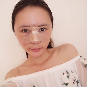 濟(jì)南海峽趙廣生做的自體耳軟骨墊鼻尖+硅膠隆鼻前后對比照片分享