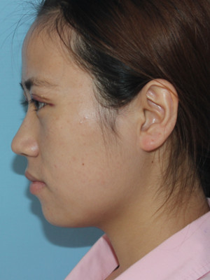 濟(jì)南海峽謝燕燕做的切開雙眼皮，分享前后對(duì)比照片以及恢復(fù)過程