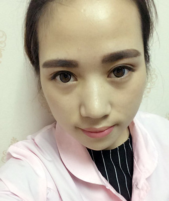 濟(jì)南海峽謝燕燕做的切開雙眼皮，分享前后對(duì)比照片以及恢復(fù)過程