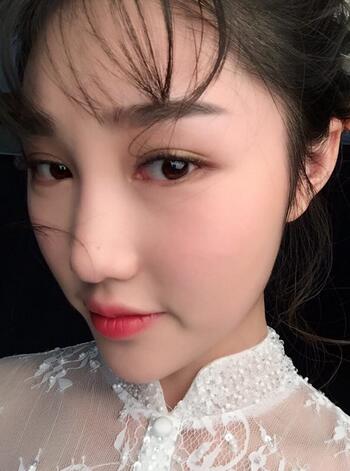 成都蜀尚蓉雅割雙眼皮+開眼角真實案例