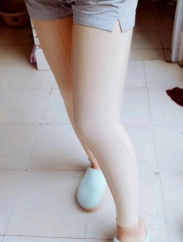 武漢詮美大腿吸脂后恢復(fù)過(guò)程