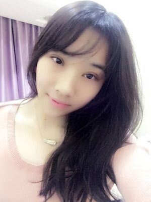 洛陽(yáng)孔繁榮切開(kāi)雙眼皮+開(kāi)眼角手術(shù)恢復(fù)過(guò)程圖