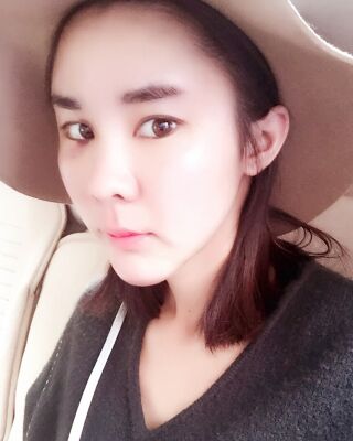 自體脂肪面部填充三個(gè)月果圖分享，減齡十歲