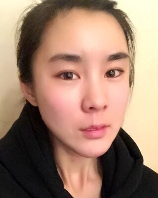 自體脂肪面部填充三個(gè)月果圖分享，減齡十歲