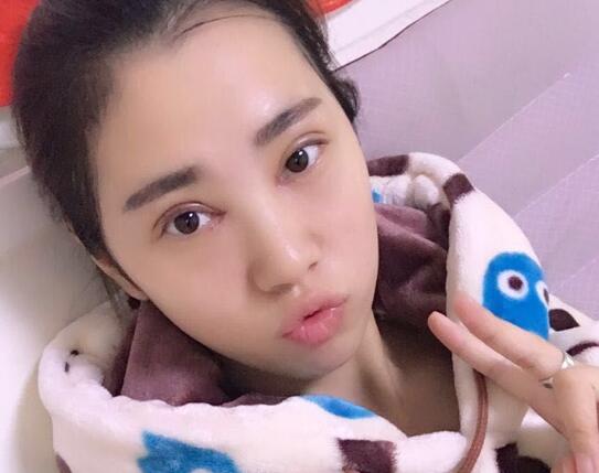 開眼角+割雙眼皮真實(shí)案例前后對比圖分享——四川悅好整形