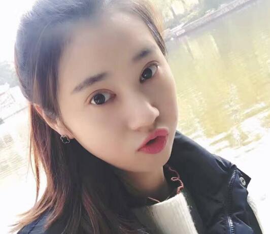 開眼角+割雙眼皮真實(shí)案例前后對比圖分享——四川悅好整形