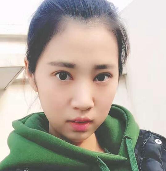 開眼角+割雙眼皮真實(shí)案例前后對比圖分享——四川悅好整形