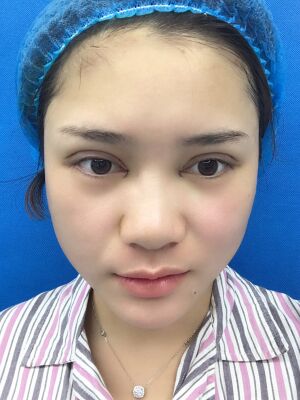 洛陽維多利亞歐式雙眼皮手術(shù)恢復(fù)過程圖，真實(shí)案例圖