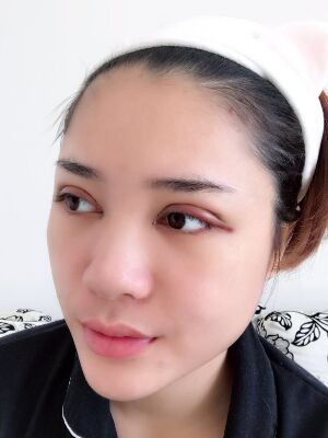 洛陽維多利亞歐式雙眼皮手術(shù)恢復(fù)過程圖，真實(shí)案例圖