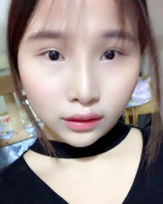 仇侃敏韓式隆鼻整形恢復果對比照片