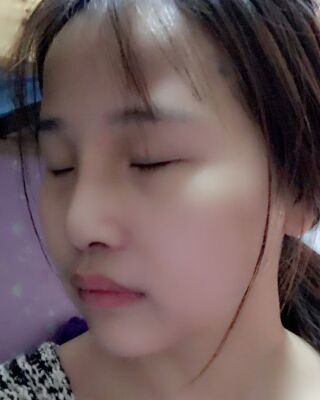 仇侃敏韓式隆鼻整形恢復果對比照片