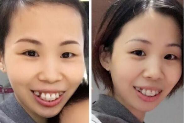 牙齒矯正的很好的年齡，多對比圖真實案例分享——成都格林口腔