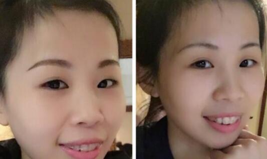 牙齒矯正的很好的年齡，多對比圖真實案例分享——成都格林口腔