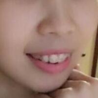 牙齒矯正的適宜年齡，多對比圖真實案例分享——成都格林口