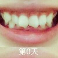 成人牙齒矯正費用9800元——成都格林口腔醫(yī)院