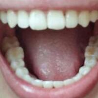 成人牙齒矯正費用9800元——成都格林口腔醫(yī)院