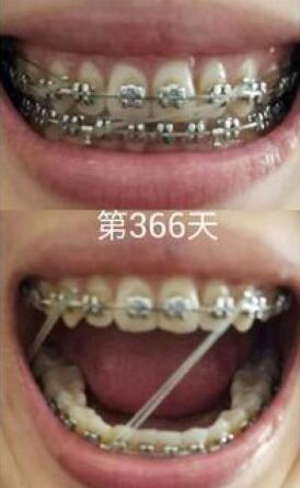 牙齒矯正前后對(duì)比圖，成人牙齒矯正費(fèi)用9800元——成都格林口腔醫(yī)院
