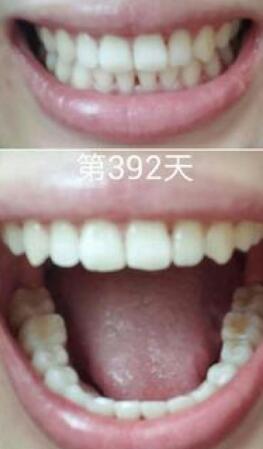 牙齒矯正前后對(duì)比圖，成人牙齒矯正費(fèi)用9800元——成都格林口腔醫(yī)院