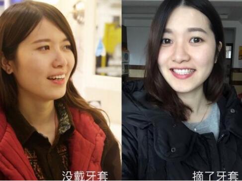 成都牙齒矯正前后對(duì)比圖分享——成都格林口腔