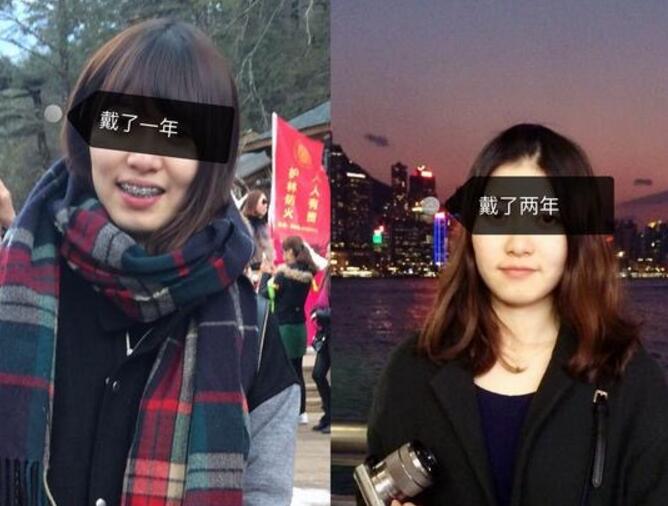 成都牙齒矯正前后對(duì)比圖分享——成都格林口腔