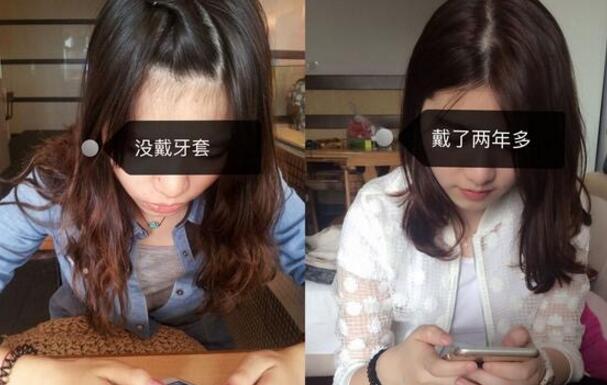 成都牙齒矯正前后對(duì)比圖分享——成都格林口腔