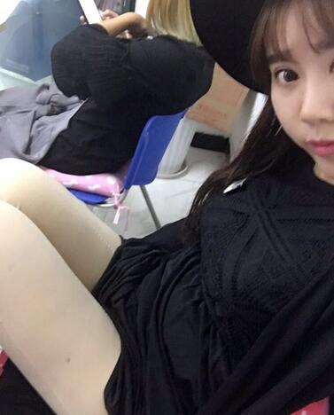 上海九院曹衛(wèi)剛大腿抽脂后恢復(fù)圖