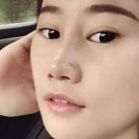 假體隆鼻恢復(fù)時間2個月真實案例分享——成都魅麗經(jīng)緯