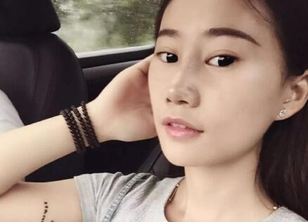 假體隆鼻前后對比圖，假體隆鼻恢復時間2個月真實案例