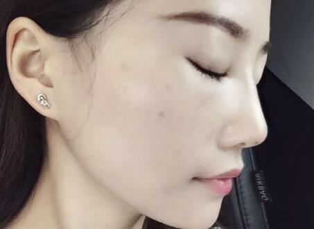 假體隆鼻前后對比圖，假體隆鼻恢復時間2個月真實案例