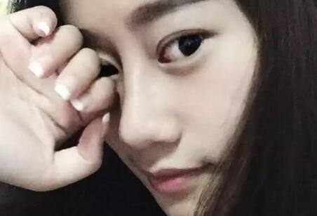 假體隆鼻前后對比圖，假體隆鼻恢復時間2個月真實案例