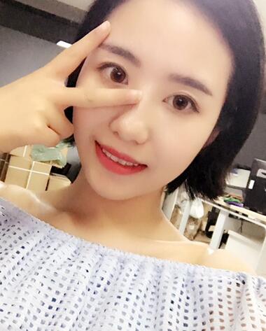 武漢憶美凱德去眼袋手術(shù)后兩個(gè)月照片