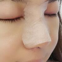 歪鼻子矯正整形恢復(fù)過程和對比圖分享——成都魅麗經(jīng)緯醫(yī)療