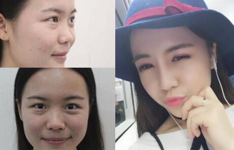 隆鼻整形前后對比圖，歪鼻子矯正整形恢復(fù)過程