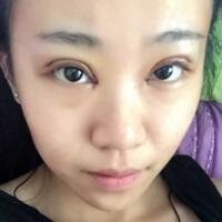 在成都魅麗經(jīng)緯做單眼皮變雙眼皮整形恢復(fù)過(guò)程和對(duì)比圖分享